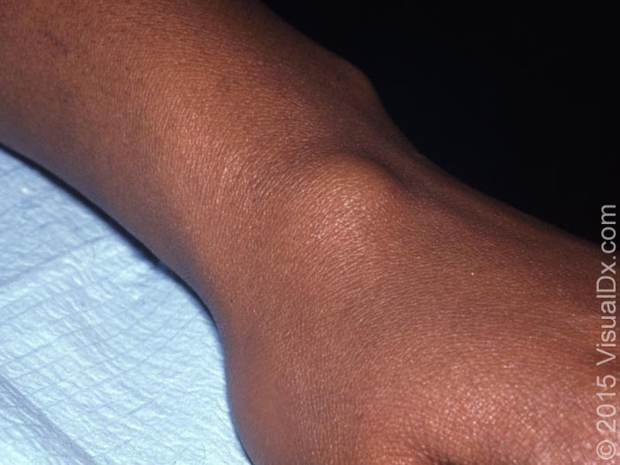 骨科医生手腕囊肿,骨科医生能看腱鞘囊肿吗