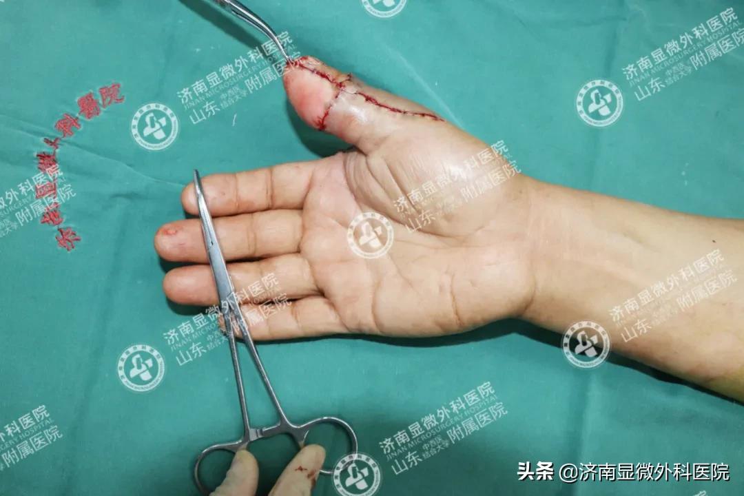 手指少了一块肉怎么处理,手指少了一截