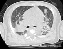 医护奋战27小时救回羊水栓塞产妇,广西驰援武汉护士抢救26天