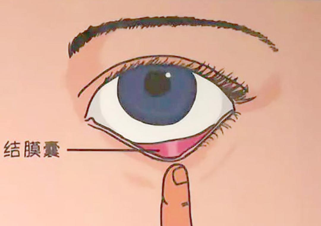 眼药水为啥滴到血管瘤部位,眼药水应该滴在眼睛什么位置