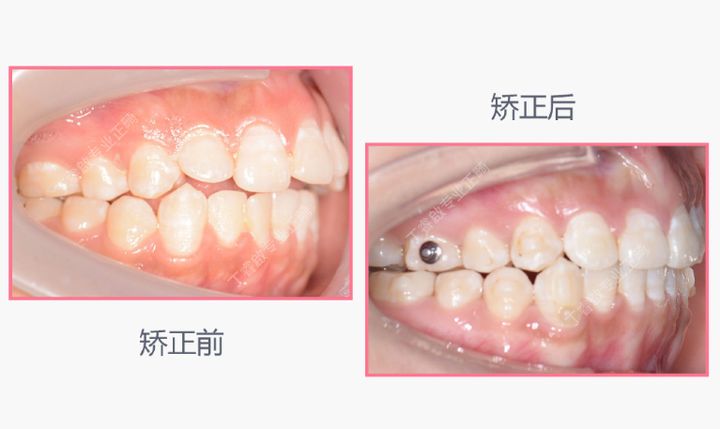 单颗牙隐形矫正,郑州隐形矫正牙齿哪家便宜