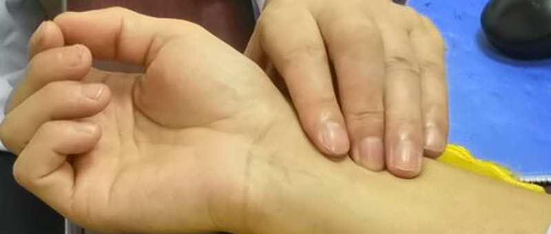 慢性前列腺炎经典案例,怎样治疗慢性前列腺炎排尿不畅