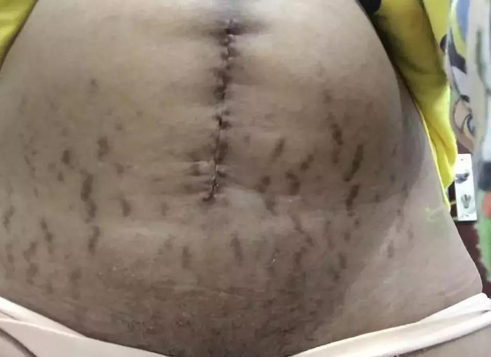 产后漏尿可自愈办法,一位母亲产后抑郁漏尿