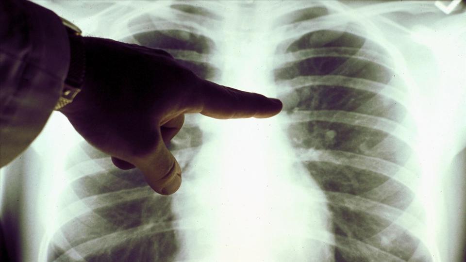 靶向药出现耐药怎么办,靶向药容易耐药的原因