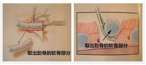 协和整形美容科专家,北京协和整形鼻综合