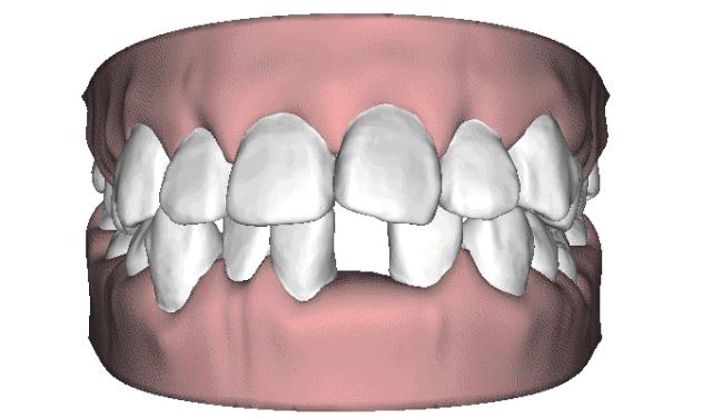 牙齿像塞东西一样胀疼要洗牙吗,牙齿像塞满东西胀疼