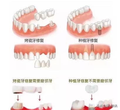 烤瓷牙价格表图种植牙,种植牙与烤瓷牙利与弊