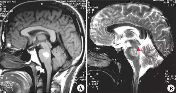 最凶险的脑干出血几毫升也要命,医生提醒:做好5点就能远离它
