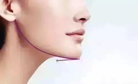 隆下巴后,整张脸都会变美了