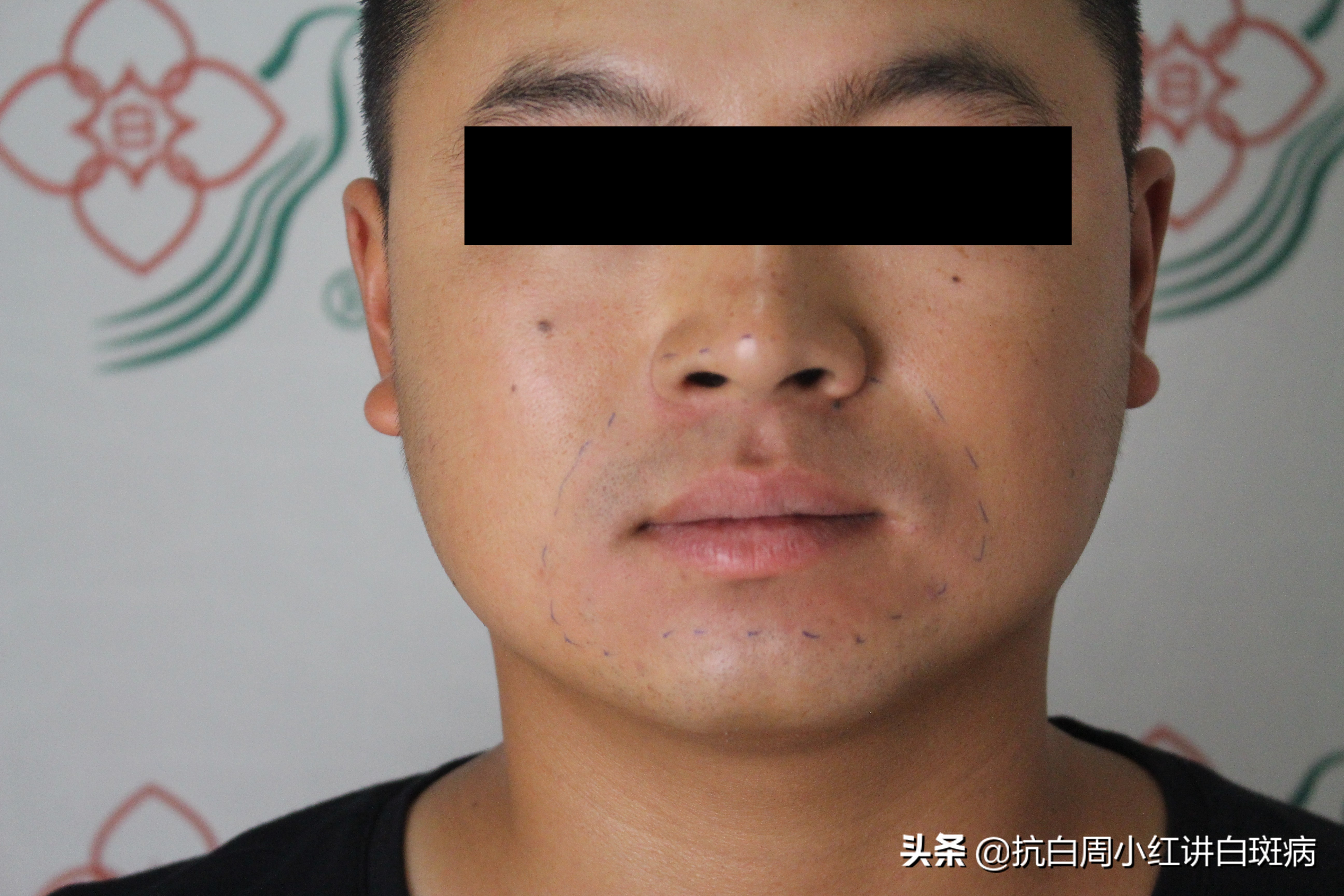 用实际康复案例详解白癜风的中医治疗，附治疗视频