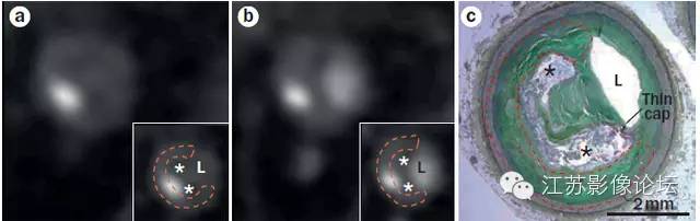 冠脉CT血管造影诊断高危斑块病变影像学特征分析