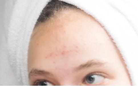 怎么样祛痘印改善肤色暗沉,祛痘印淡化痘黑印推荐