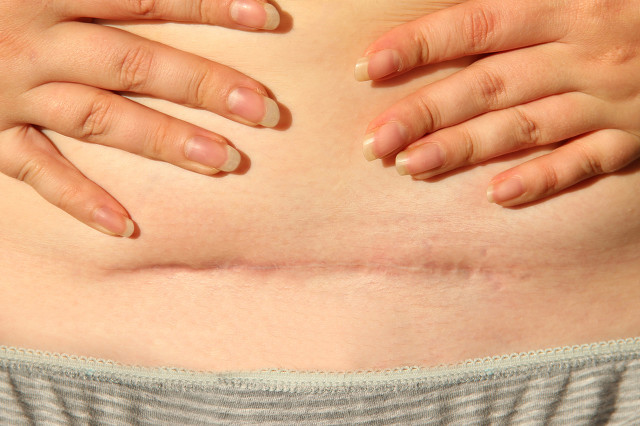 剖腹产后七个月疤痕增生疼痛,剖腹产疤痕增生像蜈蚣的照片