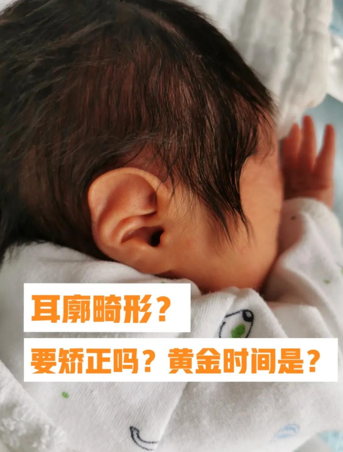宝宝刚出生耳廓畸形，现在长成什么样了？