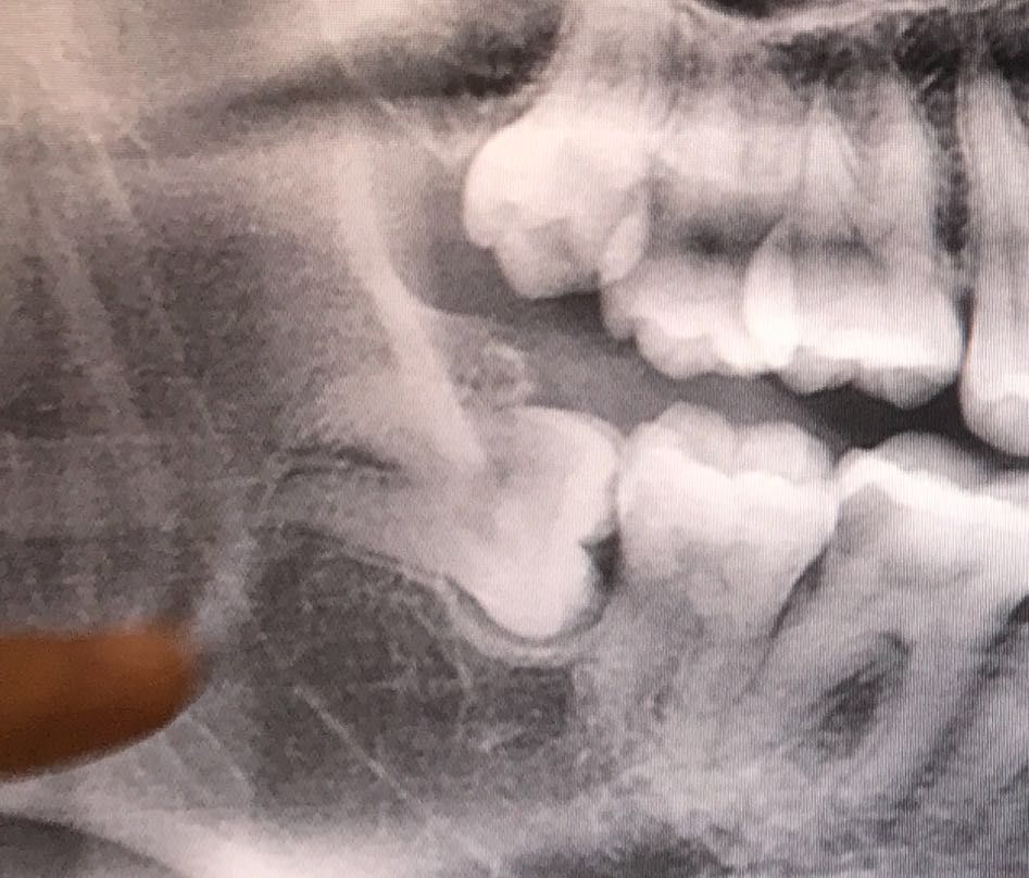 拔智齿花了260,拔智齿花了14800多