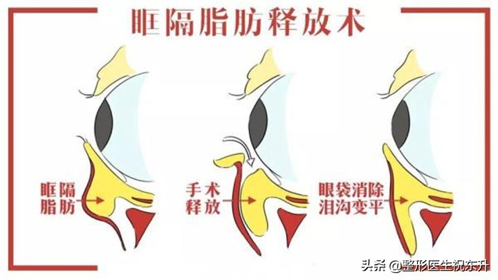 去眼袋的事情,关于祛眼袋手术这件事