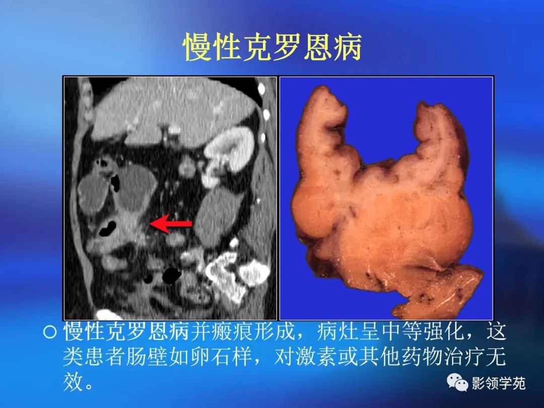 肠道内壁增厚,肠道扩张ct表现