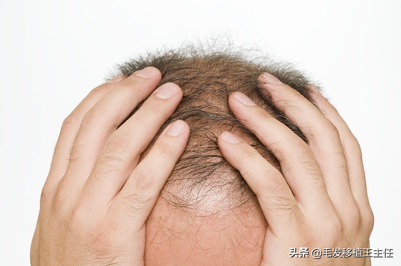 头发爱出油有头屑还痒,头痒头屑多还严重掉发怎么办