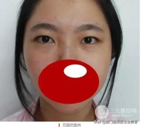 纳米无痕埋线双眼皮需不需要拆线,纳米无痕双眼皮动画操作过程视频