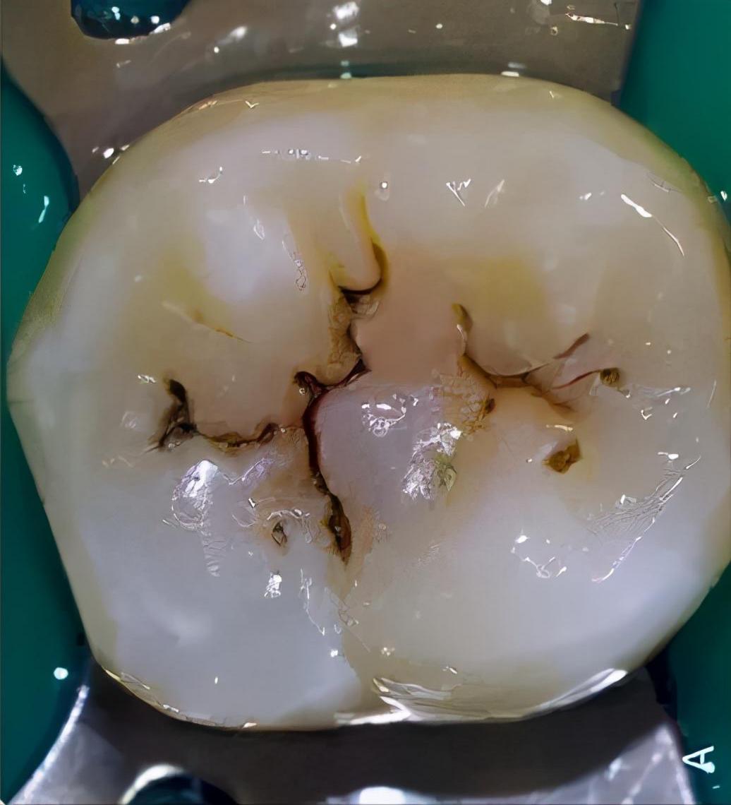 后槽牙有黑线怎么去除,牙沟上有黑线怎么办用什么刷