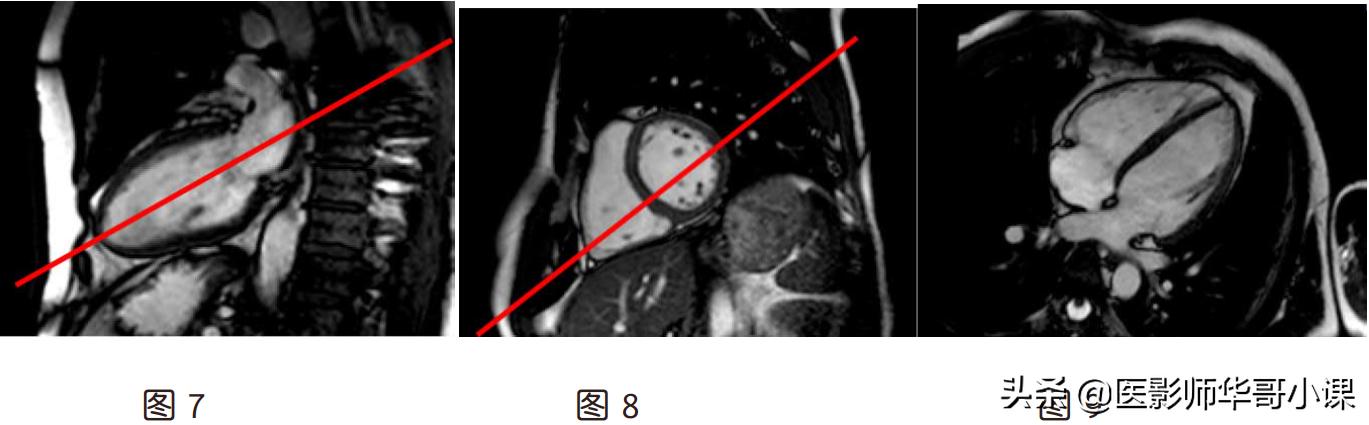 磁共振心脏扫描标准切面,心脏mri扫描定位