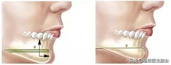 隆下巴硅胶和膨体哪个好,膨体隆下巴和硅胶隆下巴区别