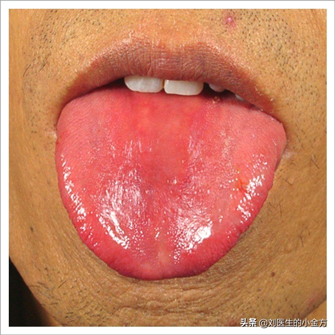 中医舌诊图解100例,中医舌诊图与舌诊口诀