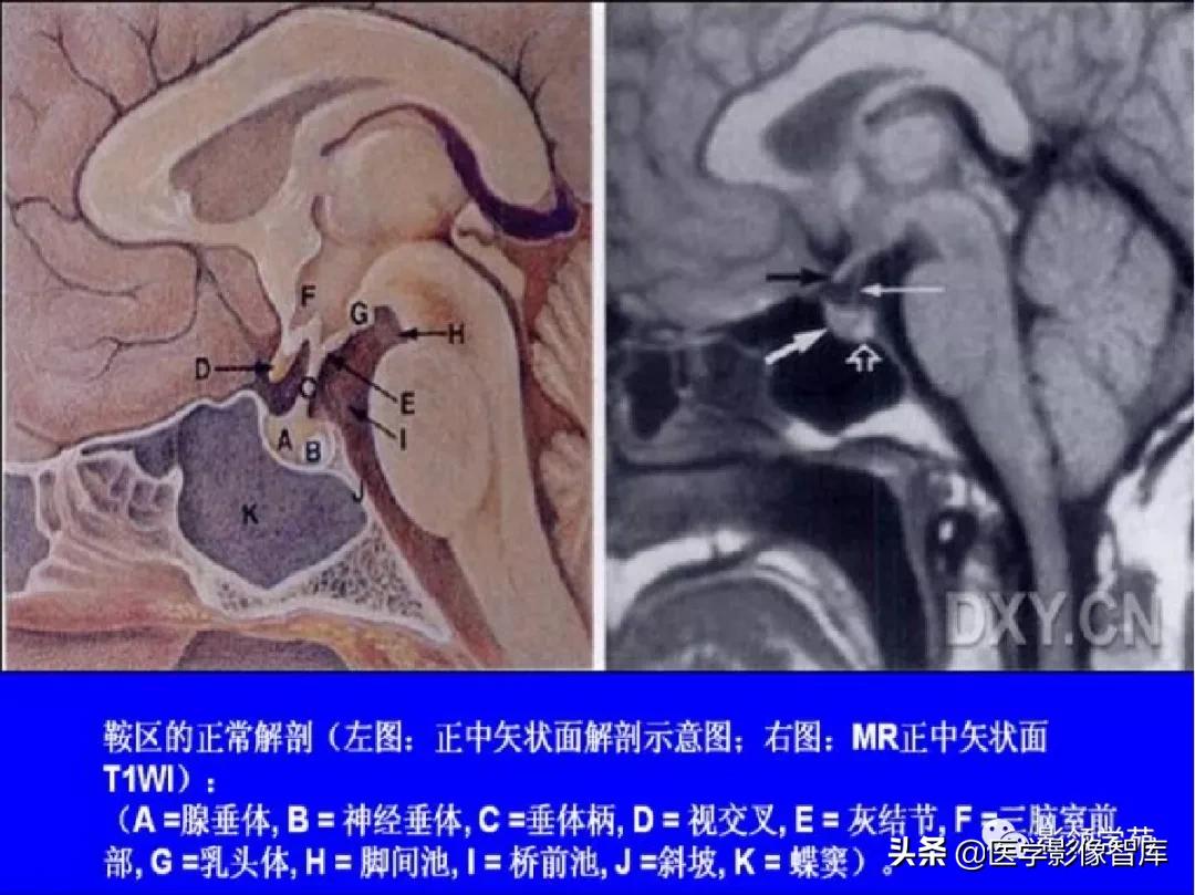 鞍区肿瘤做什么检查得出来,鞍区肿瘤的影像学鉴别