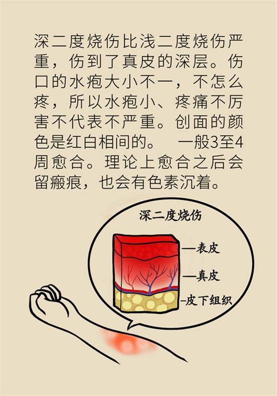 烧伤有水泡创面如何处理,烧伤烫伤起泡怎么处理