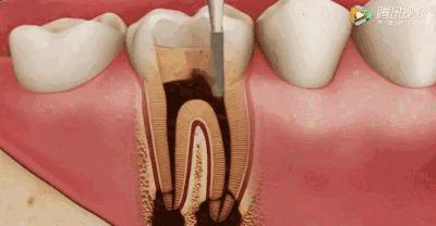 根管治疗可怕,根管治疗很恐怖吗