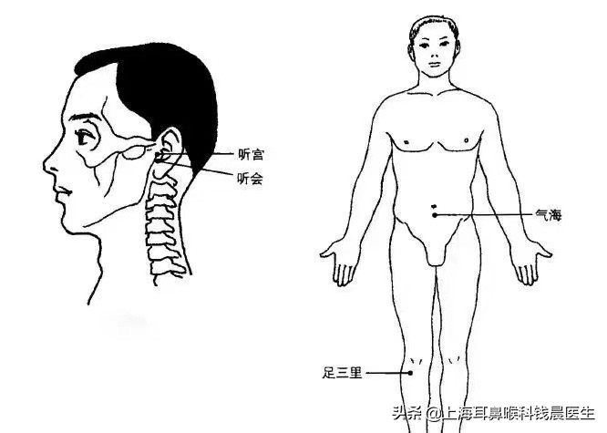 耳鸣艾灸最快的穴位,耳鸣艾灸什么穴位最见效