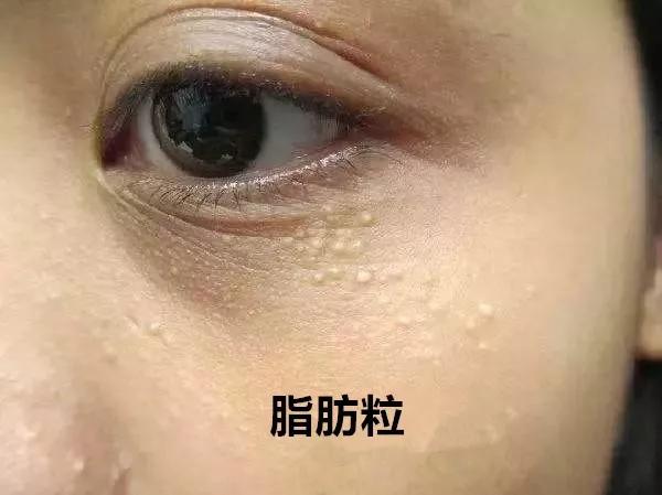 长了这么多年汗管瘤，你还以为是脂肪粒？