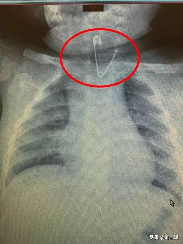 10岁孩子吞了个小钉子能排出吗,2岁宝宝误吞4厘米钉子