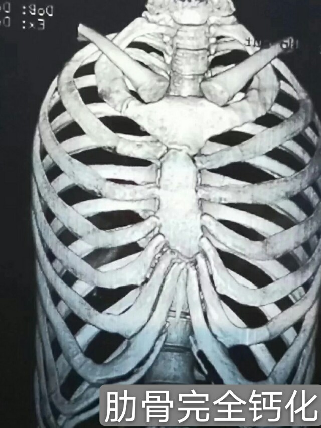 隆鼻怎么知道肋骨有没有钙化,肋骨钙化还能隆鼻吗