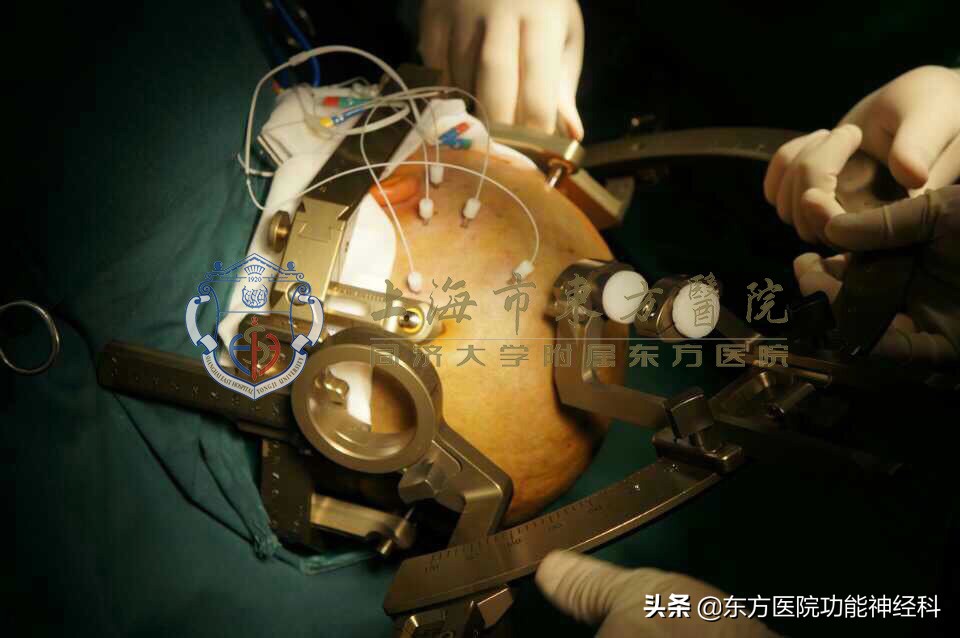 反复牙痛一定要拔牙根治吗,牙齿疼痛会诱发癫痫吗