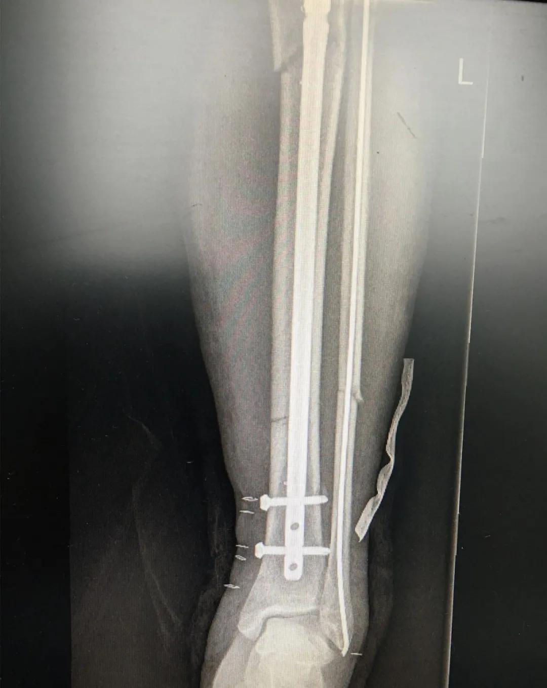 小腿挤压大量淤血能在家自愈吗,小腿碎成三截还能复原吗