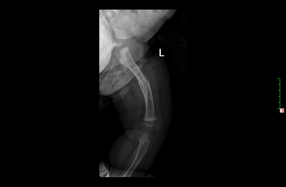 幼儿骨折误区,儿童骨折为什么好得快