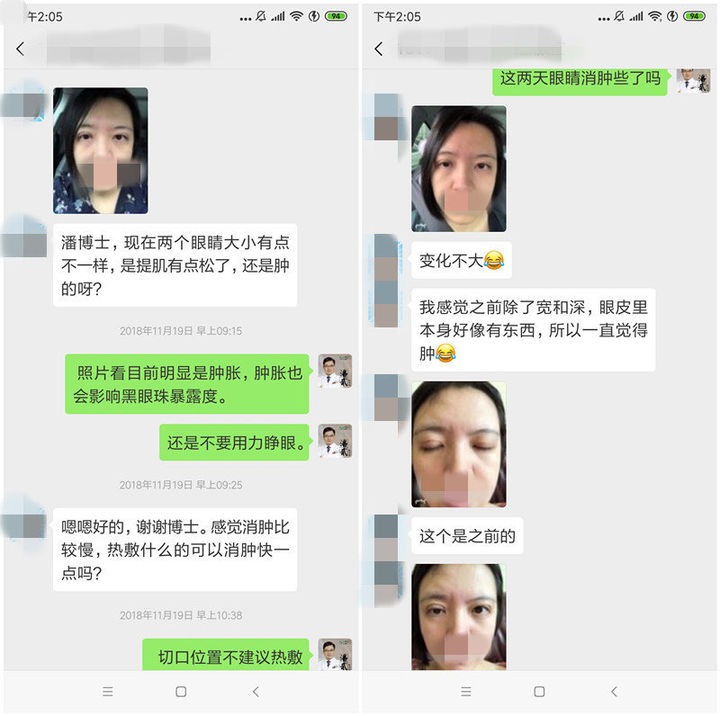 双眼皮手术后问题,双眼皮术后怎么才知道恢复好了没