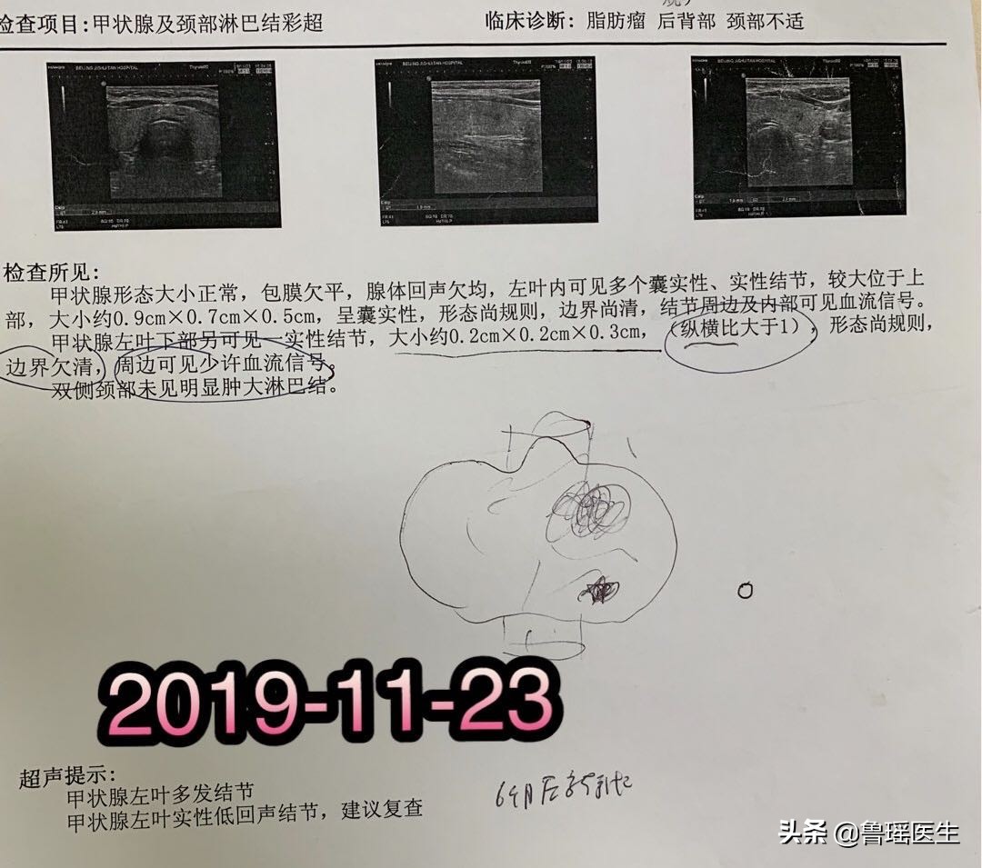 甲状腺穿刺v600e突变是什么意思,b超甲状腺结节误判率