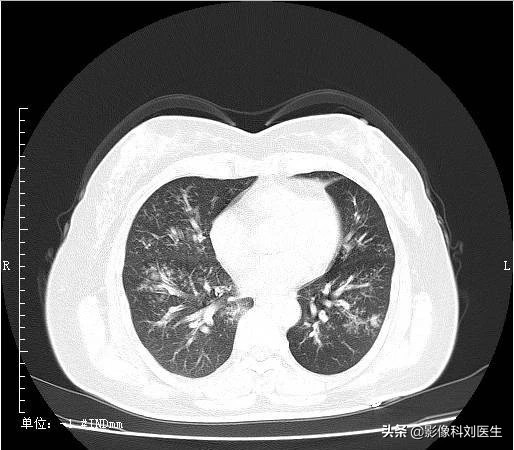 支气管肺炎x线影像,影像学肺炎与支气管炎的描述