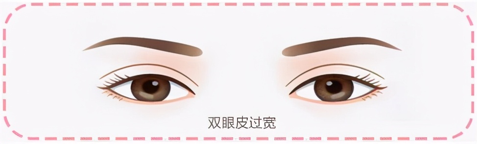 双眼皮宽深修复后三眼皮案例,修复假宽深双眼皮最好的医院