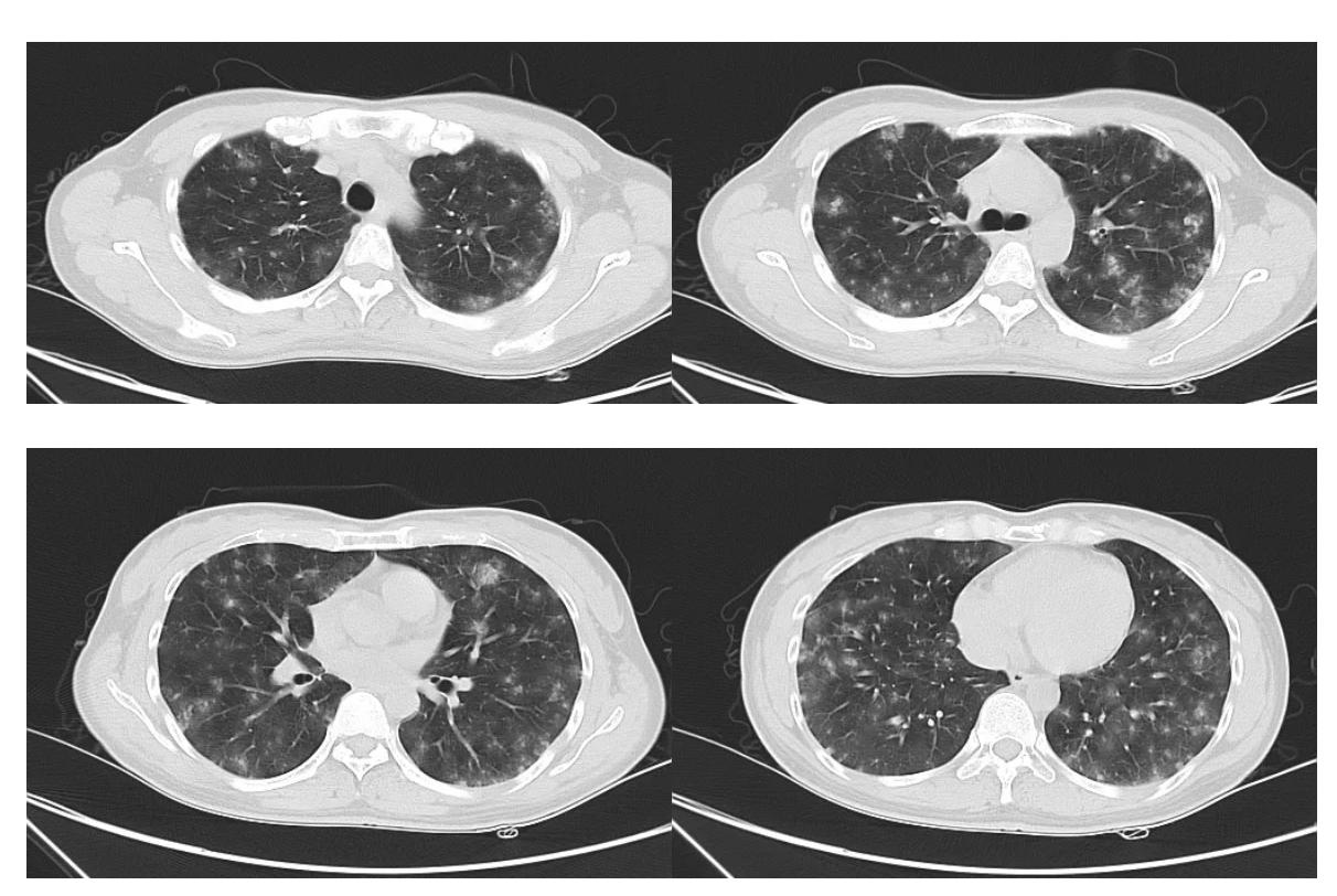 弥漫性肺泡出血是怎么回事,弥漫性肺泡出血症病因分类