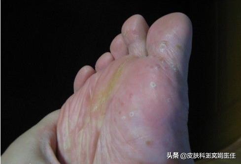 皮肤病的10种常用药治疗,18种常见皮肤病用药