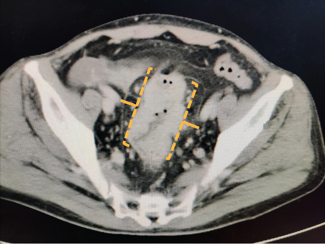 最近大便很细还拉肚子是怎么回事,平时身体挺好一生病就很严重
