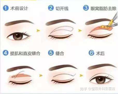 做双眼皮手术自己能看到全过程吗,全切双眼皮修复需要再次切开吗