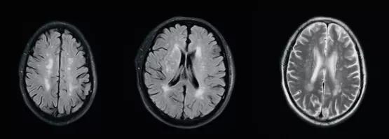 颅脑mr异常啥意思,颅脑mri未见明显异常说明什么