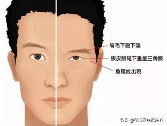 三角眼提眉有后遗症吗,三角眼提眉松弛怎么治