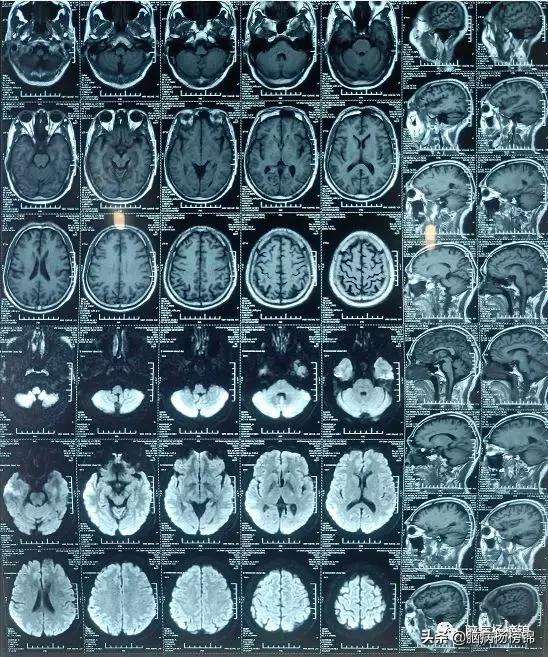 流感病毒引起的心肌梗塞,这几天的流感是怎么回事