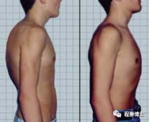 正美体态矫正脊柱侧弯真的有用吗,先天脊柱侧弯体态矫正有用吗