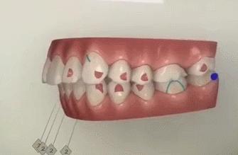 龅牙拥挤矫正需要拔牙吗,牙齿拥挤要拔智齿吗